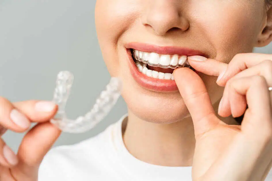 Clear Aligners by Richard Marshall DMD PLLC in Glendale, AZ