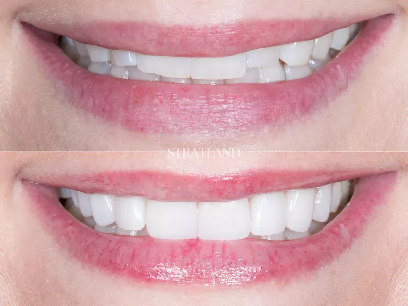 Porcelain Veneers by Cosmetic Dentist in Glendale, AZ Dr. Ricky Marshall