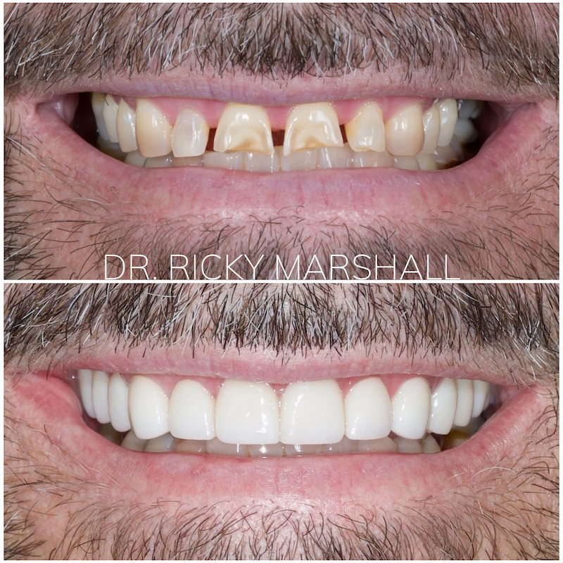 Porcelain Veneers & Crowns